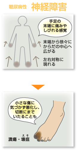 糖尿病性　神経障害