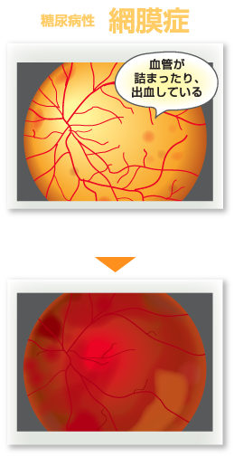 糖尿病性　網膜症