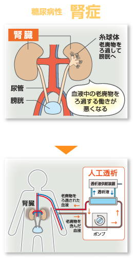 糖尿病性　腎症