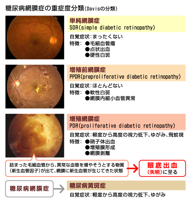 糖尿病網膜症 | 治験・モニター情報の総合掲載サイト:インクロムNAVI