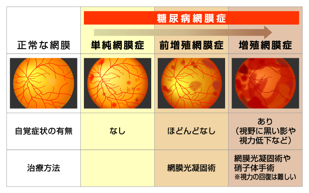 糖尿病網膜症の進行と自覚症状 | 治験・モニター情報の総合掲載サイト