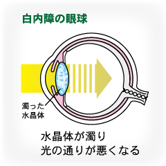 白内障とは