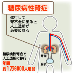 糖尿病の3大合併症の中で最も怖い、糖尿病腎症