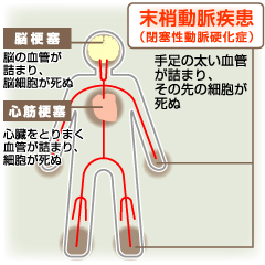 末梢動脈疾患の重症患者は、5年後に生きていられる確率40％