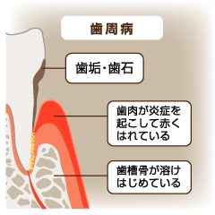 歯周病って、どんなもの？
